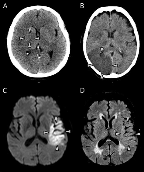 Ct And Mri Examples Of Grading Of Acute Ischemic Lesion Visibility