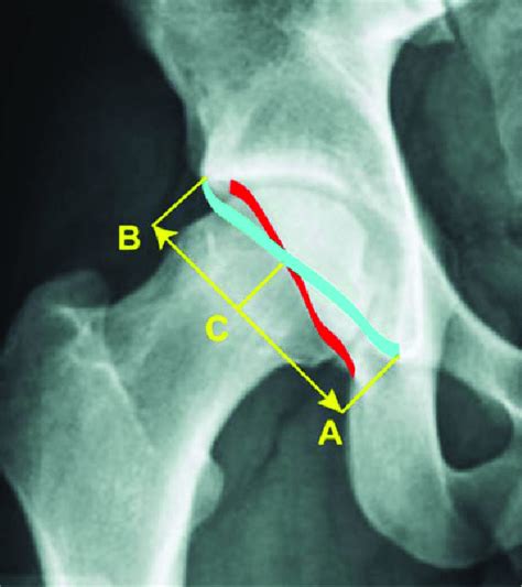 The Acetabular Retroversion Index Is Calculated By Dividing Bc By Ab