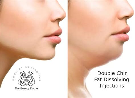 Double Chin Fat Dissolving Injections In Dublin