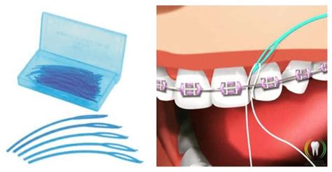 Fio Dental E Aparelho Ortodôntico 6 Dicas Para Facilitar O Uso Trindade Odontologia