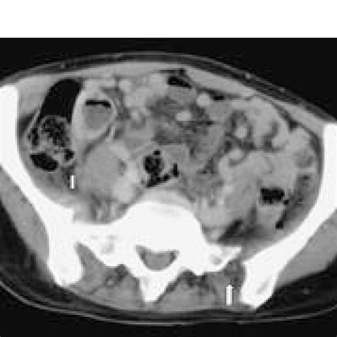 Axial Ct Scan At The Proximal Sacroiliac Si Joint Level Demonstrating