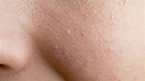 What Those Little White Dots Under Your Skin Could Be Starts At 60