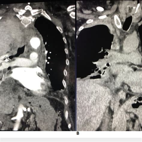 A Coronal Ct Angiogram Demonstrating Extrapleural Hematoma