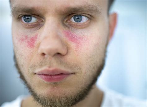 Is Rosacea A Sign Of Lupus Balmonds