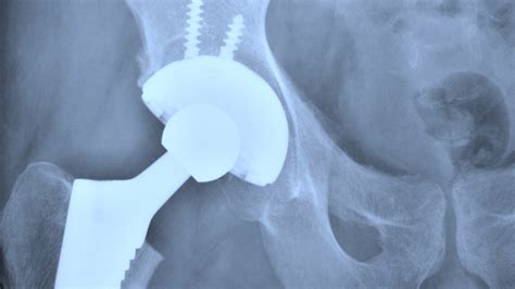 Hse To Order Artificial Hip Review
