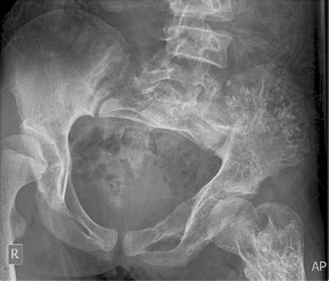 Multiple Lytic Lesions With Punctate Calcifications In The Left Iliac