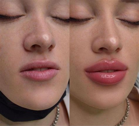 Lábios RENOVADOS Labios Aumento de labios Tipo de labios