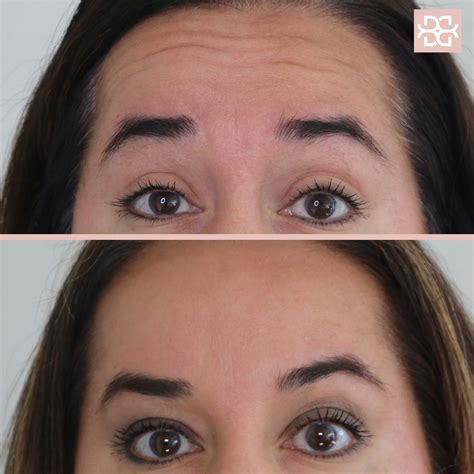 Botox For Forehead Lines The Miracle Shortcut To Look Younger Reverasite