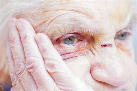 Elderly Skin Bruising Everything You Need To Know Mobility With Love