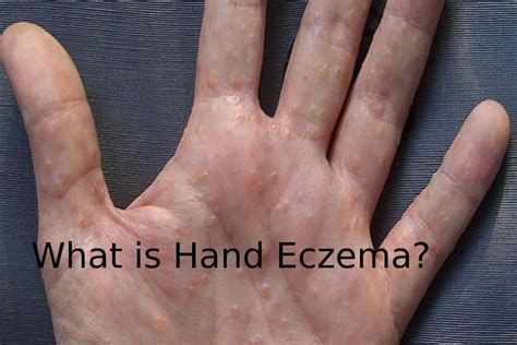 What Is Hand Eczema Produced Treatment And More