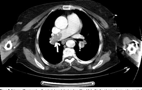Figure 2 From The Diagnosis Of Pulmonary Embolism Without Contrastis
