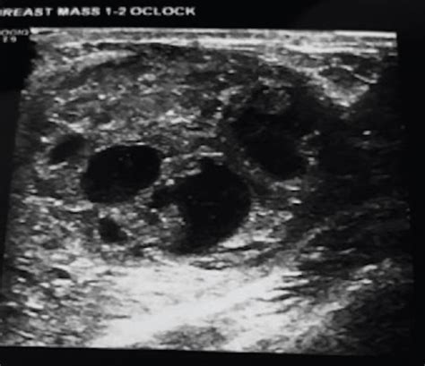 Breast Cyst Ultrasound