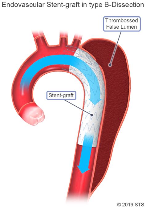Aortic Dissection The Patient Guide To Heart Lung And Esophageal
