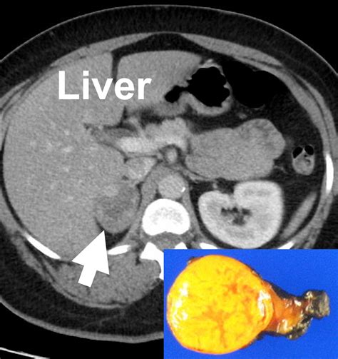 X Rays Ct Scans Mri And Other Tests For Adrenal Glands 2022