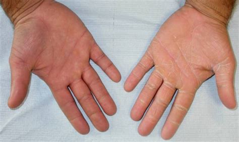 Tinea Manuum Causes Symptoms And Treatment