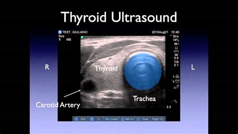 Neck Ultrasound Youtube