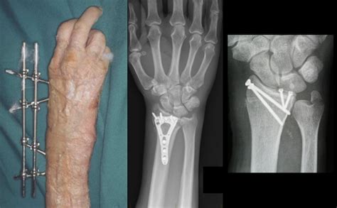 Distal Radius Bone Fracture