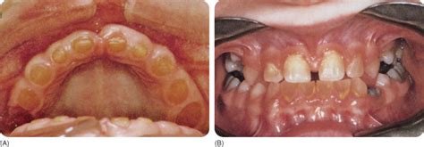 10 Discoloration Of Teeth Pocket Dentistry