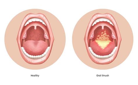 Signs And Symptoms Of Oral Thrush