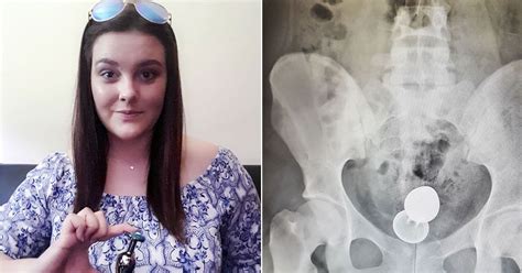 Woman Issues Warning After Having Four Inch Sex Toy Surgically Removed