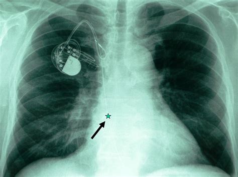 Early Complications After Pacemaker Implantations Intechopen