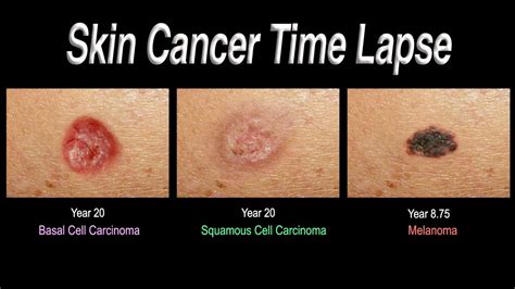 Skin Cancer Time Lapse Basal Cell Carcinoma Squamous Cell Carcinoma Melanoma Youtube