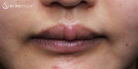 【20代女性・口唇のバランスを改善】プレミアム口角挙上、下口唇ヒアルロン酸注入、上口唇ヒアルロニダーゼ注入（施術後1ヶ月） 症例写真 美容整形、美容外科なら聖心美容クリニック
