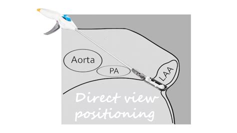 Anterior Pathway For Epicardial Left Atrial Appendage Clip Occlusion
