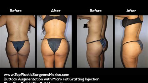 Companies in the financial sector know that giving credit can benefit many that is to say, you first must have residency in mexico before you can apply for a loan. BRAZILIAN BUTT LIFT, BUTTOCK AUGMENTATION WITH FAT ...