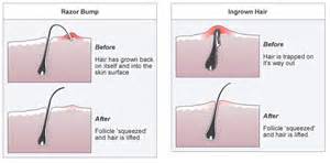 Dare To Bare Shaving Tips For Pubic Hair Removal Ask Shawna
