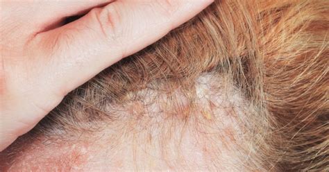 Causes Of Scaling In The Scalp Daily Nutrition News