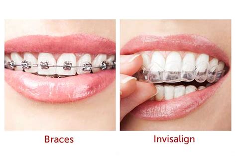 How Does Invisalign Work Compared To Braces Mydentistsinfo