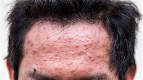 Skin Rash On Forehead Pictures Photos