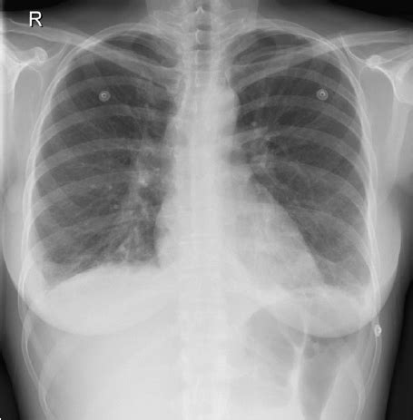 Diffuse opacities, kerley b lines. Chest x-ray: Kerley-B lines and mild bilateral pleural ...