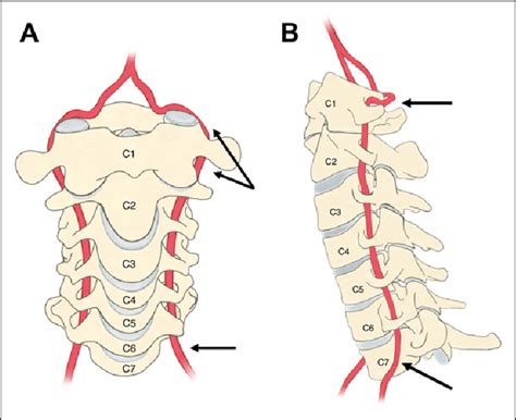 Cervical Spondylosis Problem Compared Healthy Spine Outline Diagram