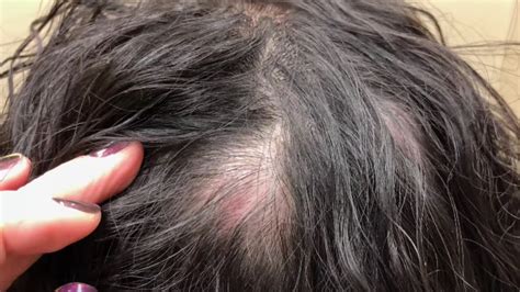 Pimple Popping Video This Woman Had Her Scalp Cyst Removedhellogiggles