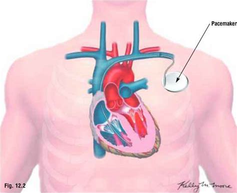 Arrhythmias Pacemakers And Defibrillators Heart Surgery