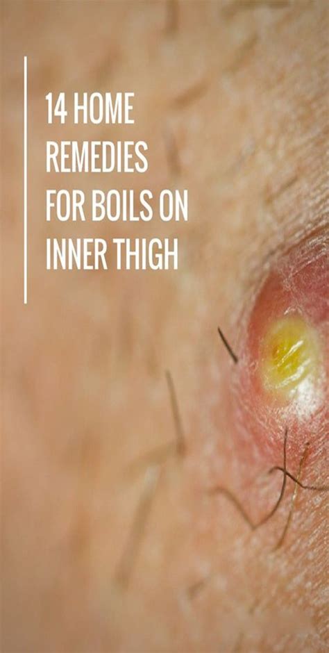 A Boil Is A Common Skin Problem That May Occur At Any Part Of The Body Such As On Ear Thighs