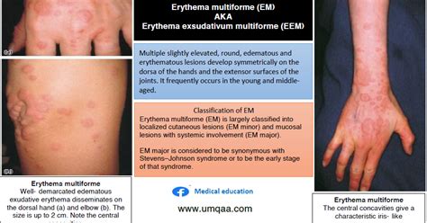 Erythema Multiforme Causes Symptoms Treatment Erythema Multiforme