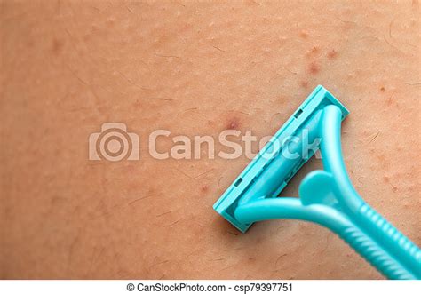 Foliculitis On Hairy Skin Shaving With Razor Close Up Picture Of