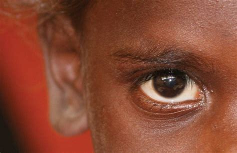 Tracking Indigenous Eye Health Mivision