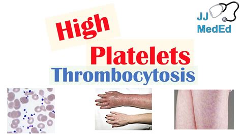 What Causes High Platelets Thrombocytosis Approach To Causes Symptoms Treatment Youtube