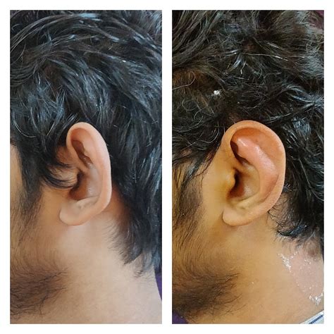 Best Otoplasty In Bangalore Ear Surgery Cost Venkat Center