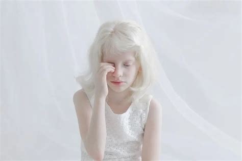 Can Albino People Dye Their Hair Everything You Need To Know After Sybil