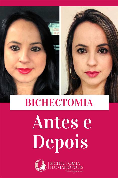 Foto Antes E Depois Da Bichectomia Beauty Piercing
