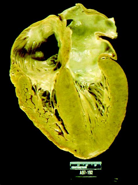 Diagnosis And Management Of The Cardiac Amyloidoses Circulation