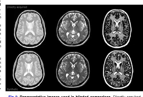 Proton density images were extensively used for. Figure 2 from Synthetic vs. directly-acquired MRI of ...