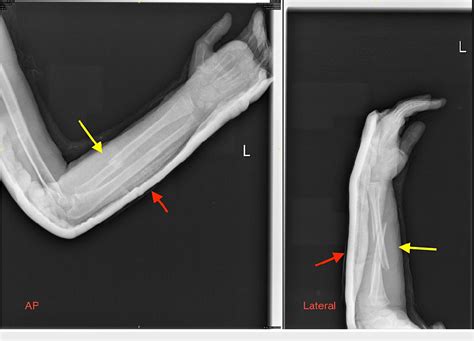 Figure 1 From Ulnar Nerve Palsy In Both Bone Forearm Fracture In A