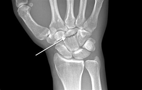 Capitate Fracture Hand Surgery Source
