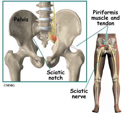 My doctor gave me muscle relaxants, which i don't like to take, and our insurance only covered four physical therapy visits. Piriformis Muscle Injections | eOrthopod.com